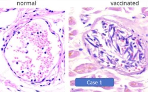 Normal Vs Vaccinated Arneburkhardt