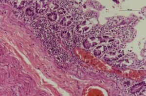 Vaccine Causes Multi Organ Inflammation V2f1s3a